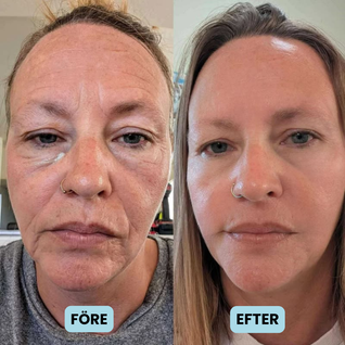 Silkyface ansiktsplåster - slipp dyra klinikbesök